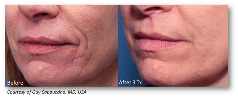 lutronic genius radiofrequency microneedling offered at jeunesse medical spa in old bridge and holmdel, new jersey 