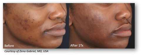 lutronic genius radiofrequency microneedling offered at jeunesse medical spa in old bridge and holmdel, new jersey