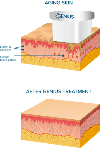 how does lutronic genius radiofrequency microneedling work in the skin?