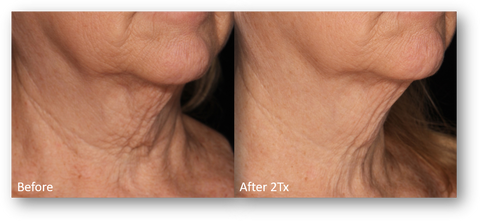 lutronic genius radiofrequency microneedling offered at jeunesse medical spa in old bridge and holmdel, new jersey 