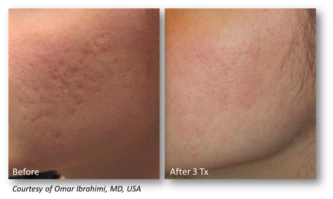 lutronic genius radiofrequency microneedling offered at jeunesse medical spa in old bridge and holmdel, new jersey