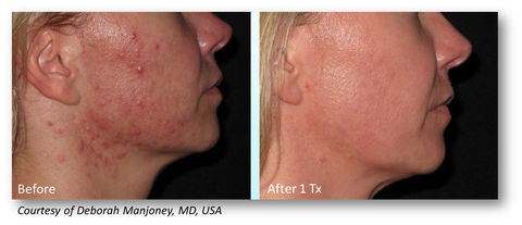 lutronic genius radiofrequency microneedling offered at jeunesse medical spa in old bridge and holmdel, new jersey 