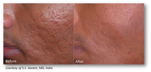 before & after lutronic genius radio frequency microneedling at jeunesse medical spa 