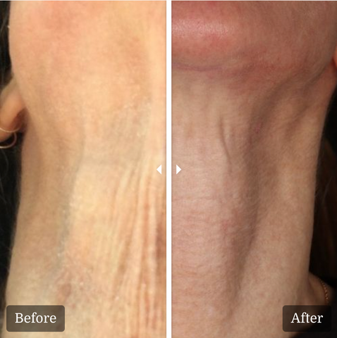 renuva hand before and after jeunesse medical spa holmdel old bridge nj new jersey