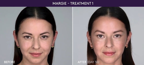 woman's before & after botox photos jeunesse medical spa holmdel old bridge nj new jersey