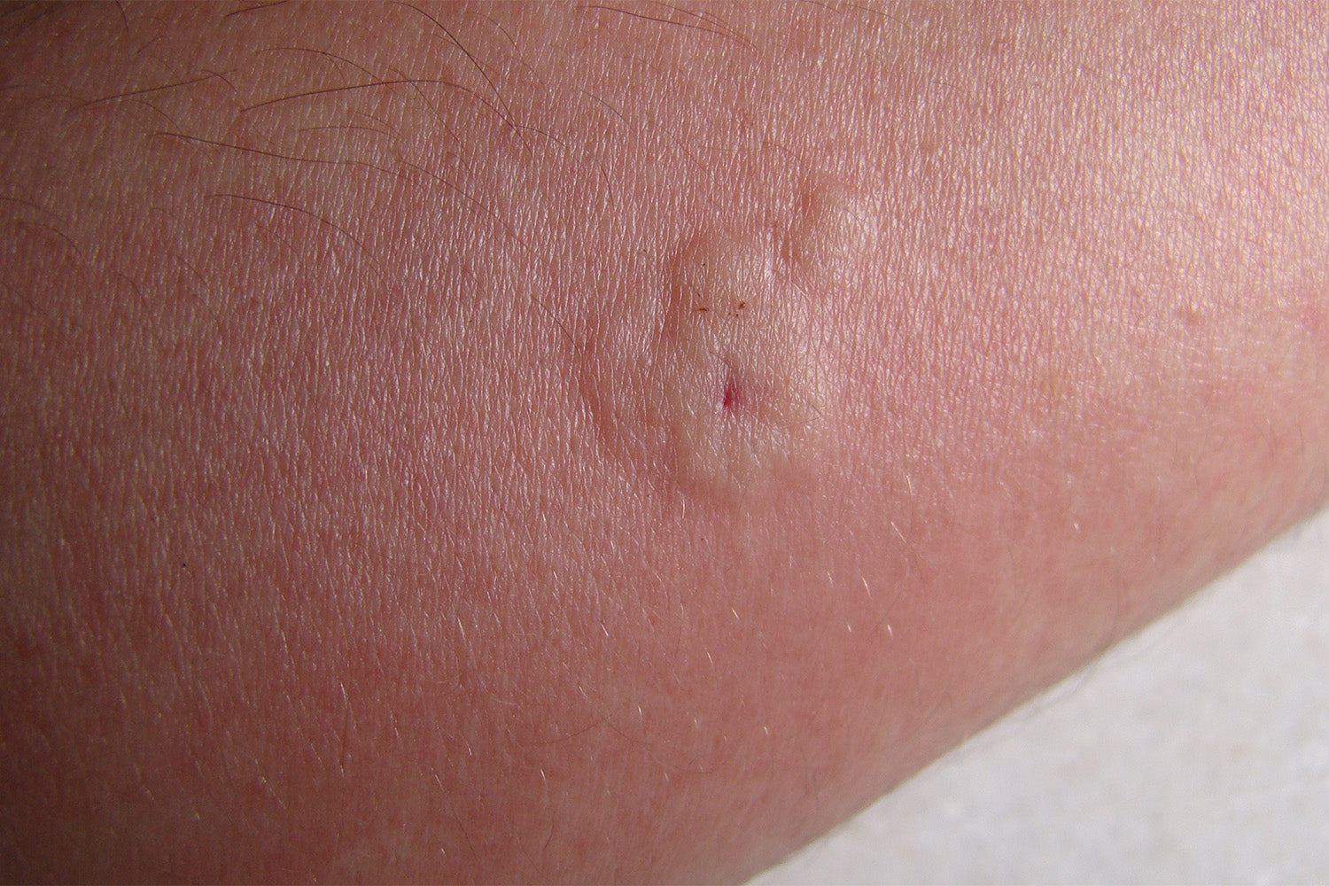 bee-sting-treatment-with-lemons-video