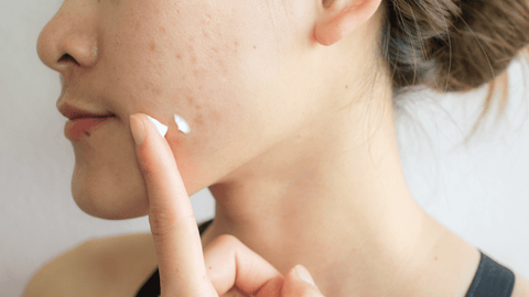 spot treatment for adult acne