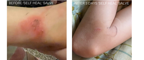 Bio first self heal salve before and after