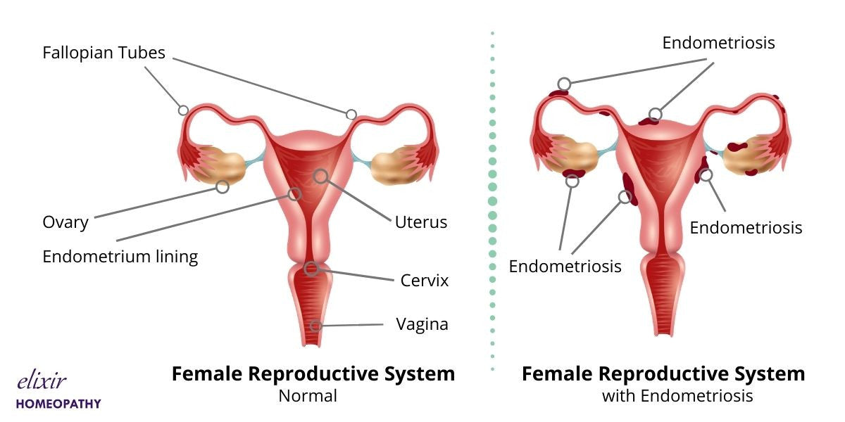 Female reproductive system of a patient suffering from Endometriosis.
