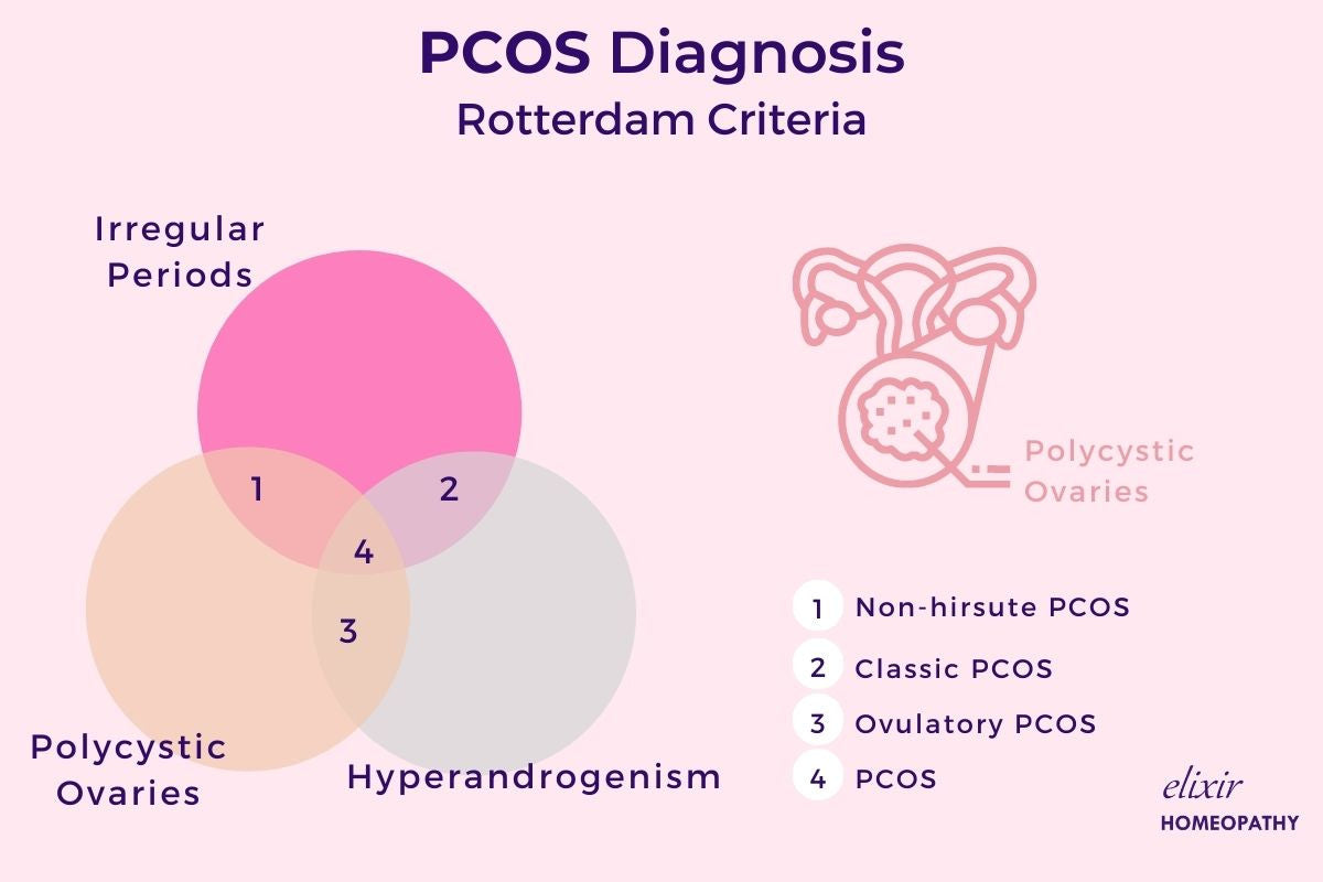 PCOS diagnosis - Rotterdam Criteria. Image explains how to diagnose PCOS in Venn diagram using Rotterdam Criteria. 