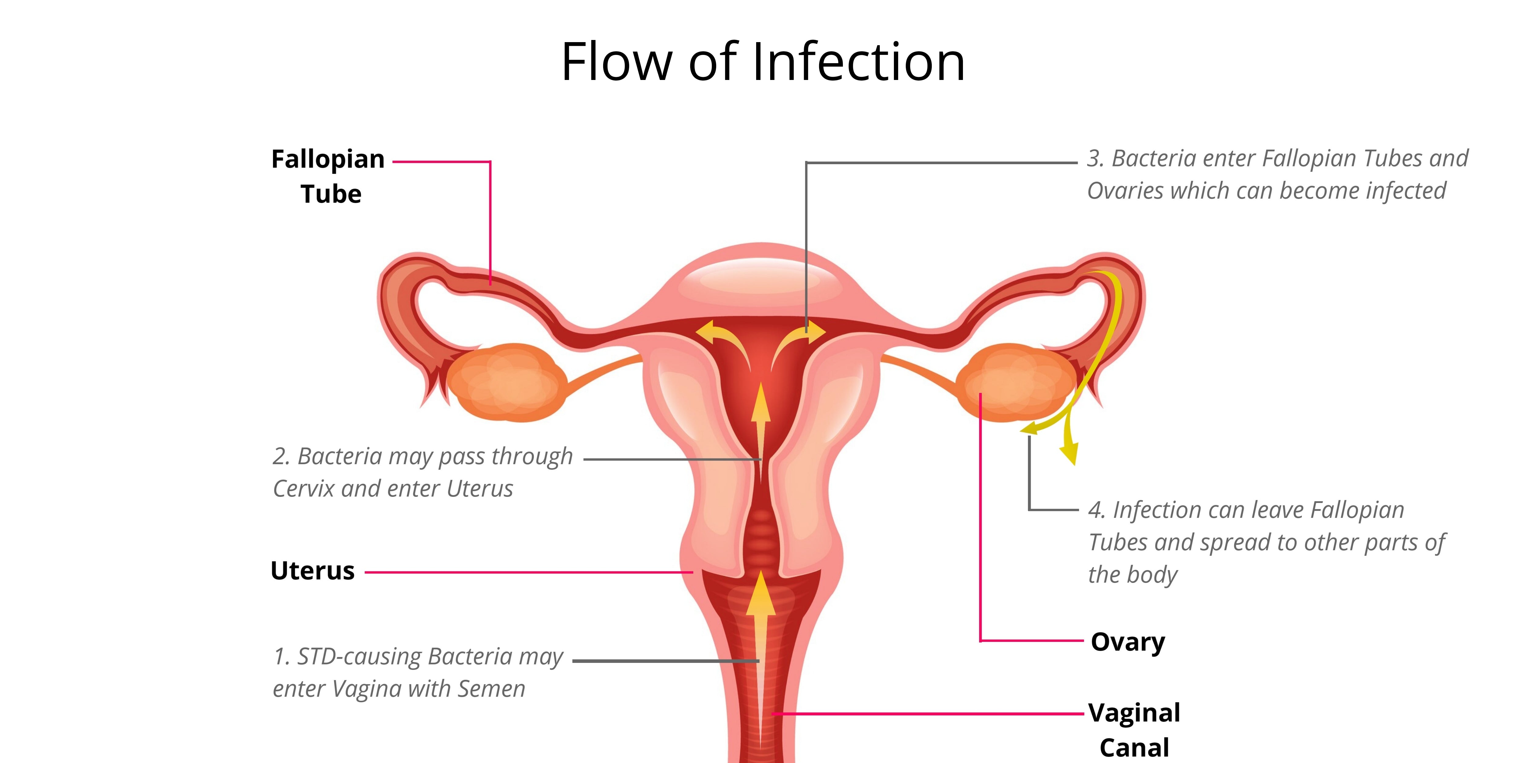 Image shows how PID infection flows and spreads in a female reproductive system.