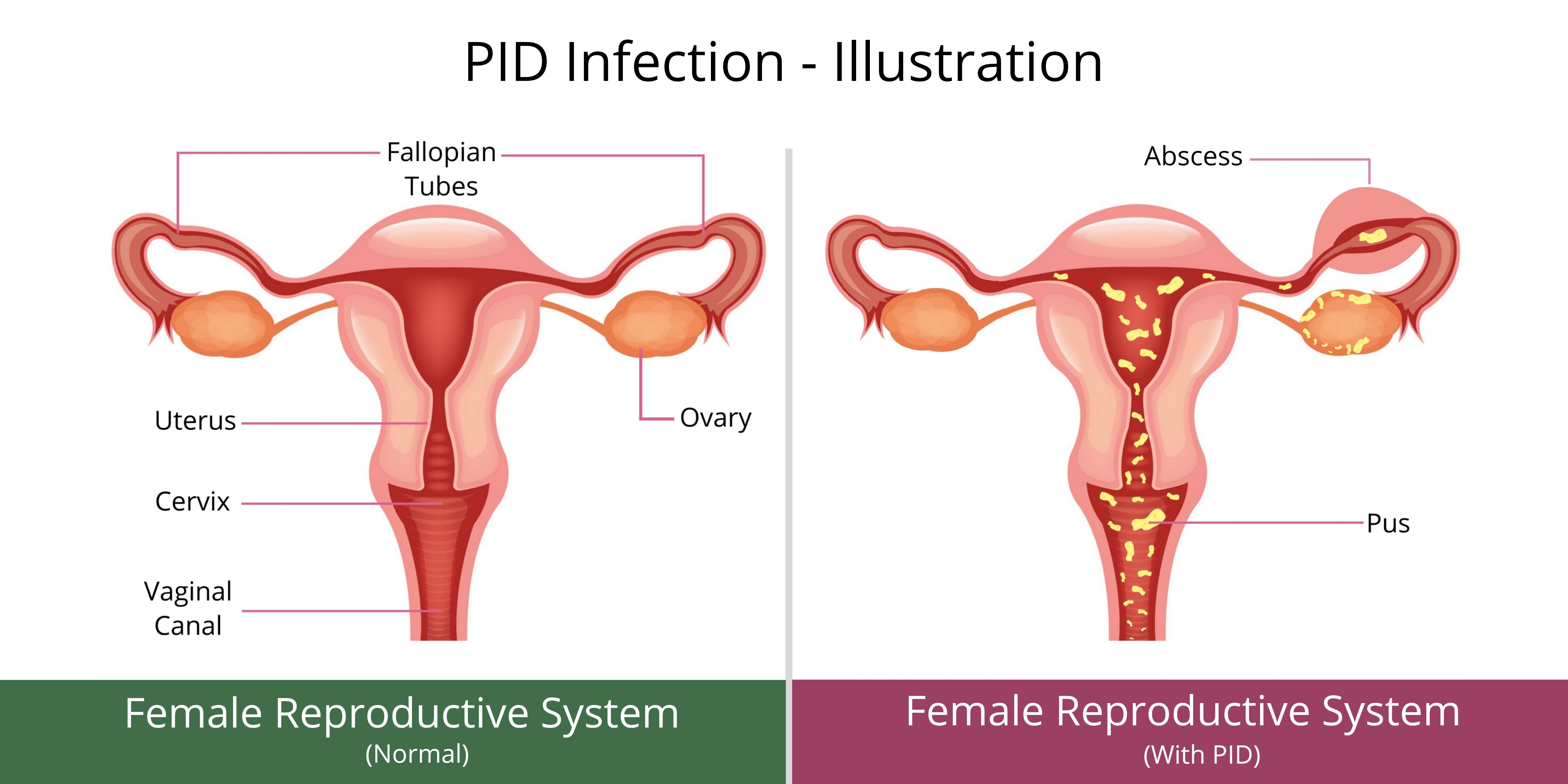 Image exhibiting PID infection in female reproductive system.