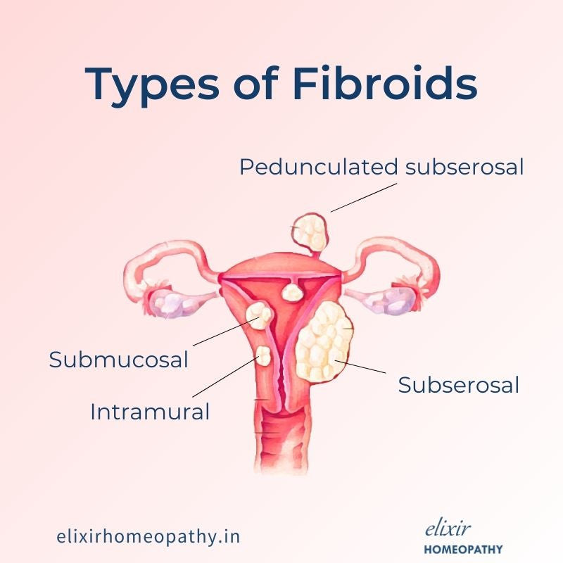 Image is a graphical representation of types of fibroids. It describes three types of uterine fibroids. Subserosal fibroids, intra-mural fibroids, and submucosal fibroids. It also shows pedunculated fibroids, which are fibroids with attached to uterus with a stock.