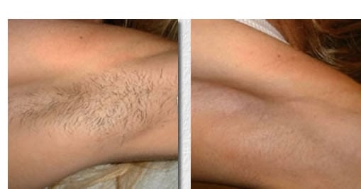ipl before after underarm