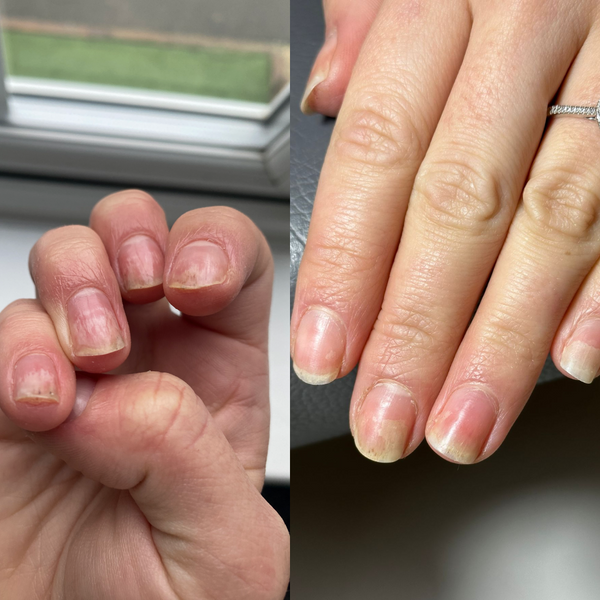 Nail Allergy Case Study