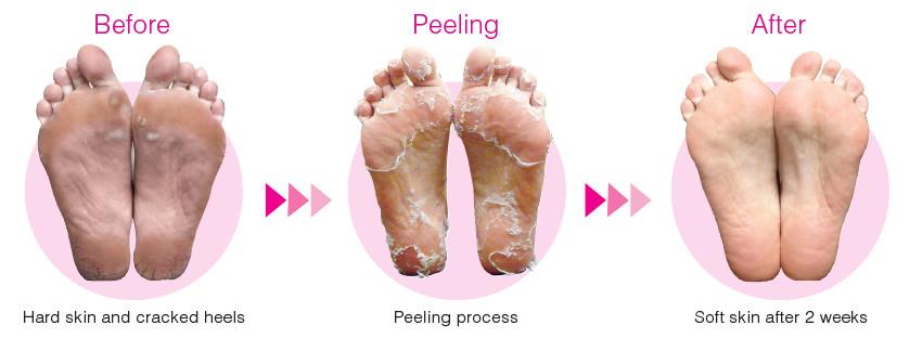 feet peeling and cracking