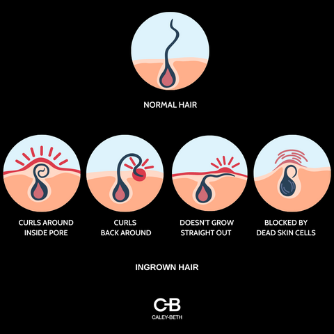 Caley-Beth, Toronto Canada.  Zero-waste, plastic free skincare for shaving.  Graphic showing normal hair verses ingrown hairs.