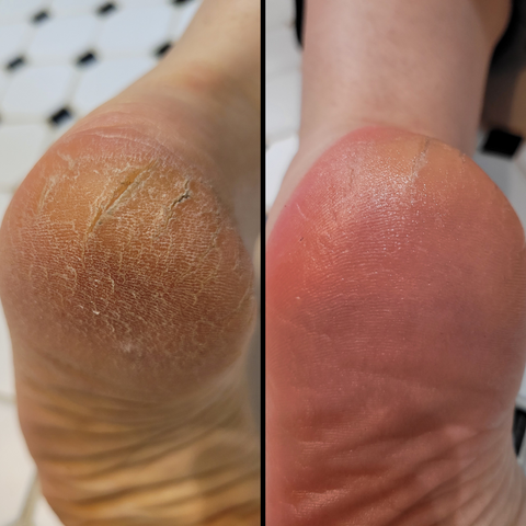 Before and After of a cracked heal and one week later after pumicing daily then applying Caley-Beth After Shave Balm Lotion Bar 