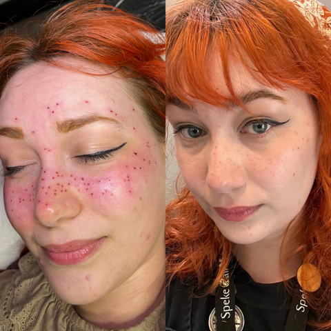 Faux Freckle Tattoo Process Healing Aftercare