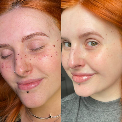 What Are Permanent Freckles? - Killer Beauty