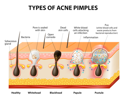Type of Acne Pimples