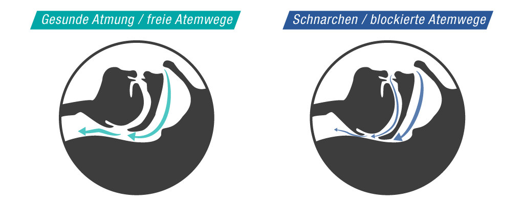 smartsleep Schlafmagazin: So entsteht Schnarchen Vergleich Freie & blockierte Atmung