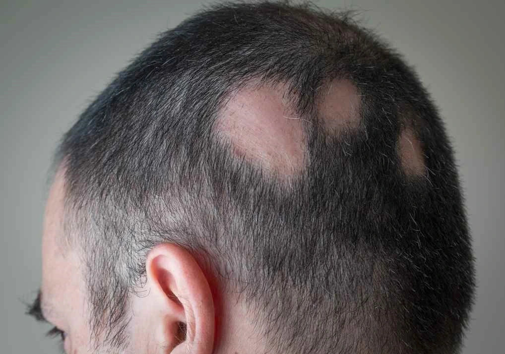 Alopecia-Areata