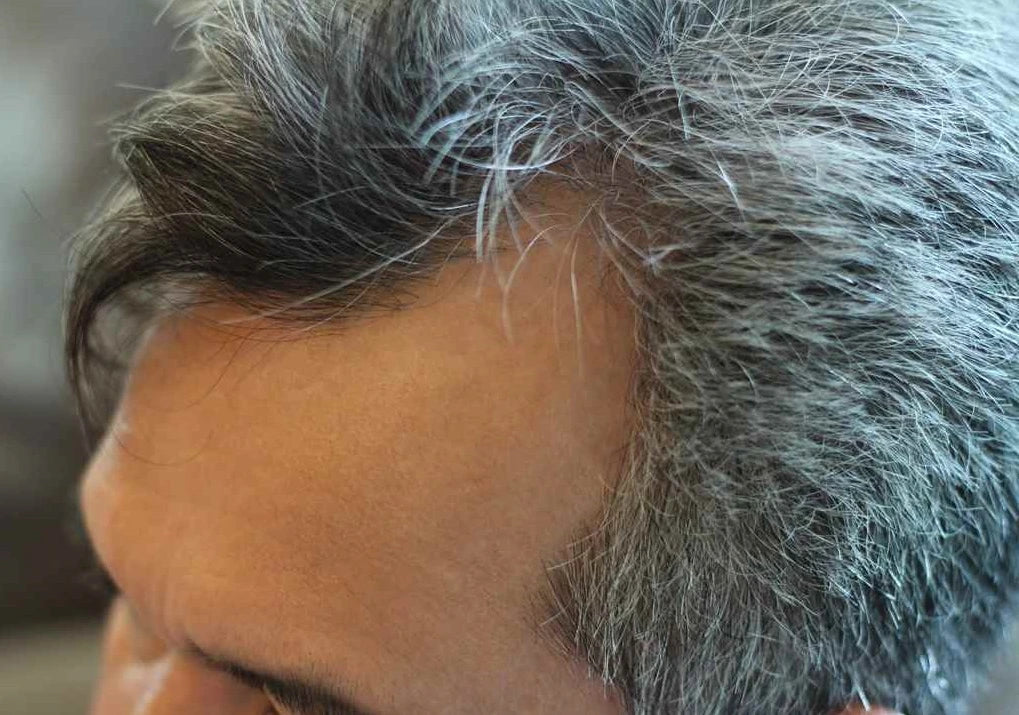 premature-greying-of-hair