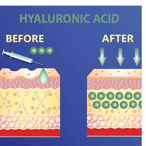 ReverseLife_BlogImage_HyaluronicAcidBefore&After