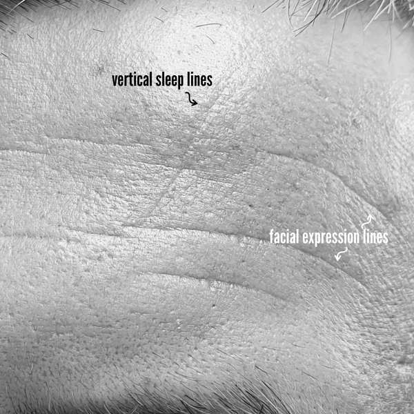 vertical sleep lines on forehead