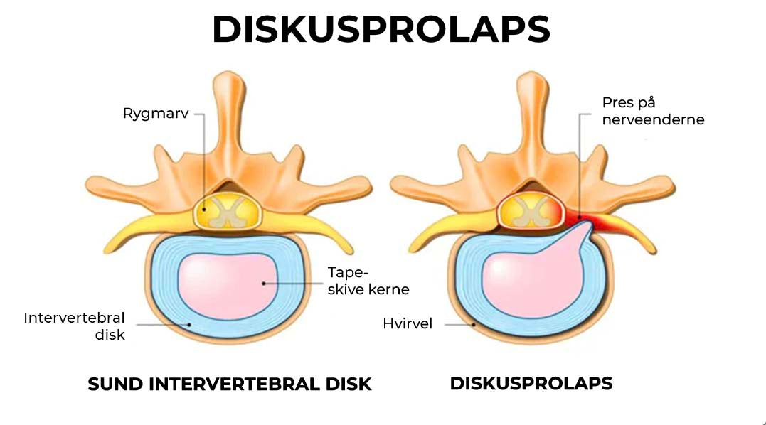 diskusprolaps-beskadiget disk