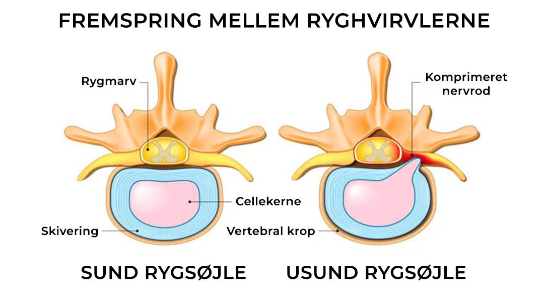 Fremspring mellem ryghvirvlerne