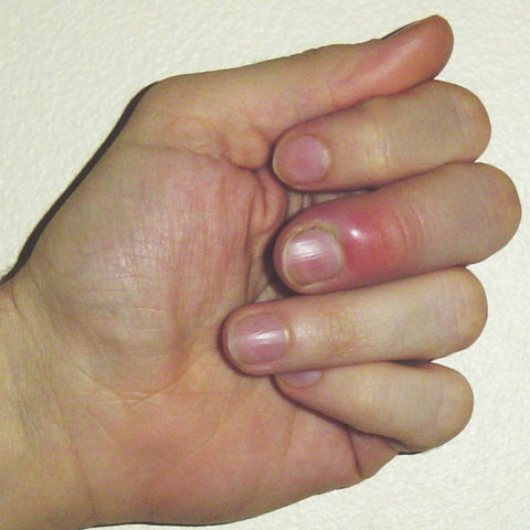 Infected finger with red swelling around the cuticle