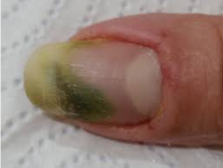 Nail with green mould underneath 