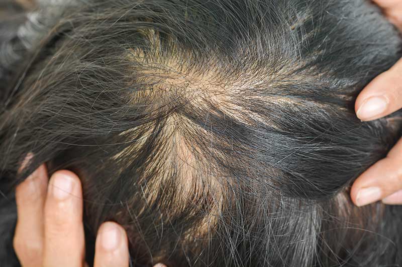 Oral Minoxidil for Hair Loss  The Expert Weighs In  Next Steps in  Dermatology