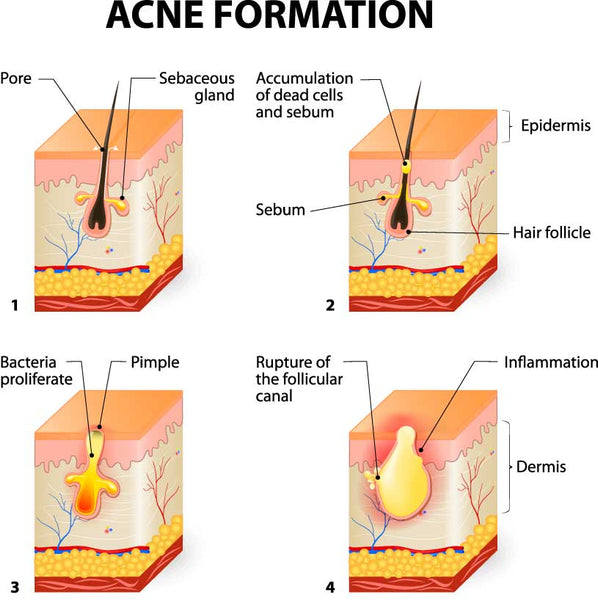 Acne formation diagram