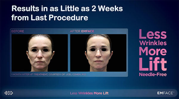 Results in as little as 2 weeks from last procedure