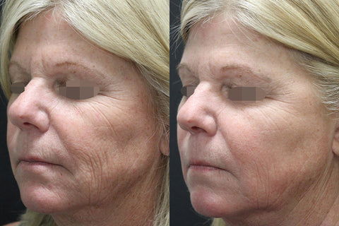 face cheek wrinkle removal by Opus Plasma