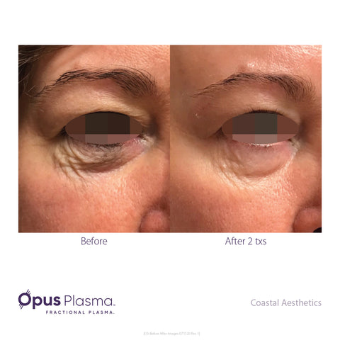 eye bag wrinkle treatment by Opus Plasma