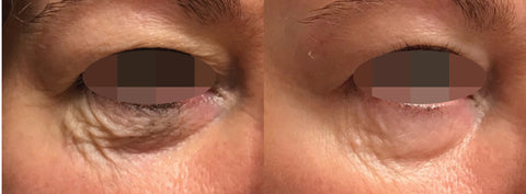 treat lower eye bag wrinkles with Opus Plasma