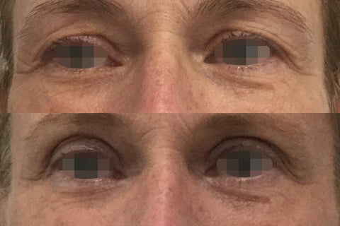 uppper eye lid lift treatment by Alma Opus at Allure Aesthetics in Bakersfield California