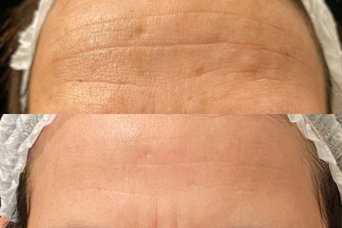 Forehead wrinkles and large pores treatment by Alma Opus at Allure Aesthetics in Bakersfield, California