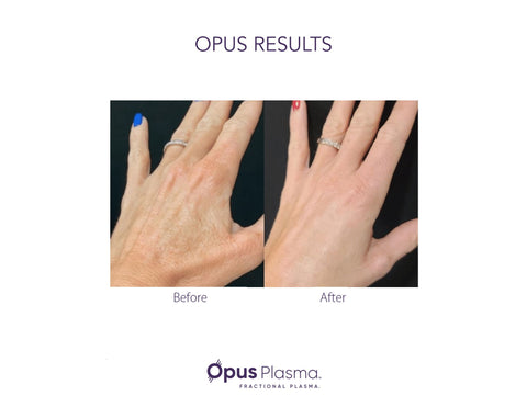 hand wrinkle removal by Opus Plasma