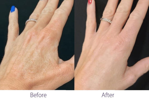 treat hand wrinkles with Opus Plasma