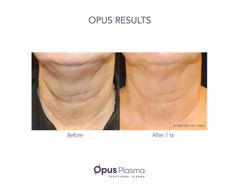 neck wrinkles removal by Opus Plasma