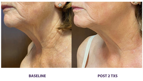 treat neck loose skin and wrinkles with Opus Plasma