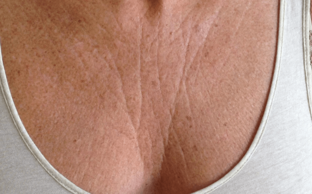 Chest Wrinkle Patch, Smooth Chest, Cleavage and Decolletage Wrinkles
