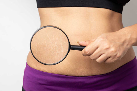 stretch mark remover