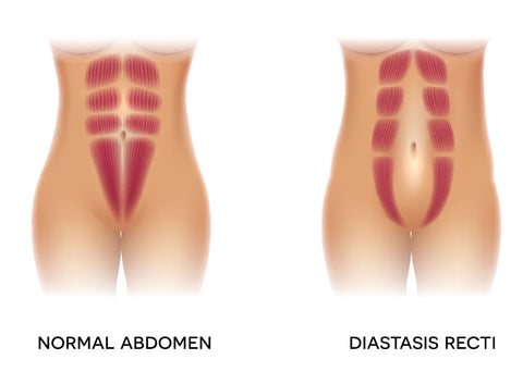 Diastis Recti postpartum