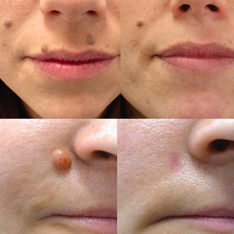 MOLE REMOVAL PEN BEFORE AND AFTER UPDATE // New Mole and Skin Tag